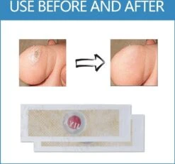 Wratten Pleisters - Tegen Druk - Anti Eelt Pleisters - 6 Stuks - Wrattenpleister - Eeltpleister -Winkel Voor Ehbo-Apparatuur 1200x1124