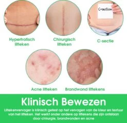 Cozy World - Littekenvervager - Verminderd Zichtbaarheid Van Littekens - Herbruikbaar - Litteken Pleister - Verwijderaar - Siliconen - Striae - Striemen -Winkel Voor Ehbo-Apparatuur 1200x1172